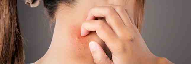 Comment repousser les moustiques sur la peau ? 1 Comment repousser les moustiques sur la peau ? 1